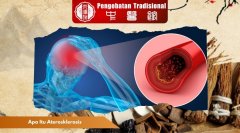 Apa Itu Aterosklerosis? Kenali Penyebab dan Bahayanya Disini