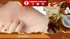 Dermatitis: Penyebab, Gejala, dan Cara Mengatasinya